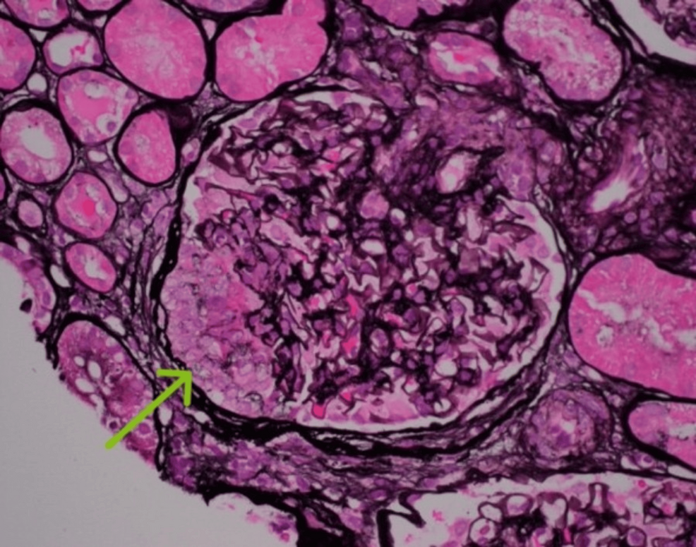 From the Hip to the Kidney: Suspected Infection-Associated Immunoglobulin A Vasculitis in the Setting of Chronic Methicillin-Sensitive Staphylococcus aureus Prosthetic Joint Infection