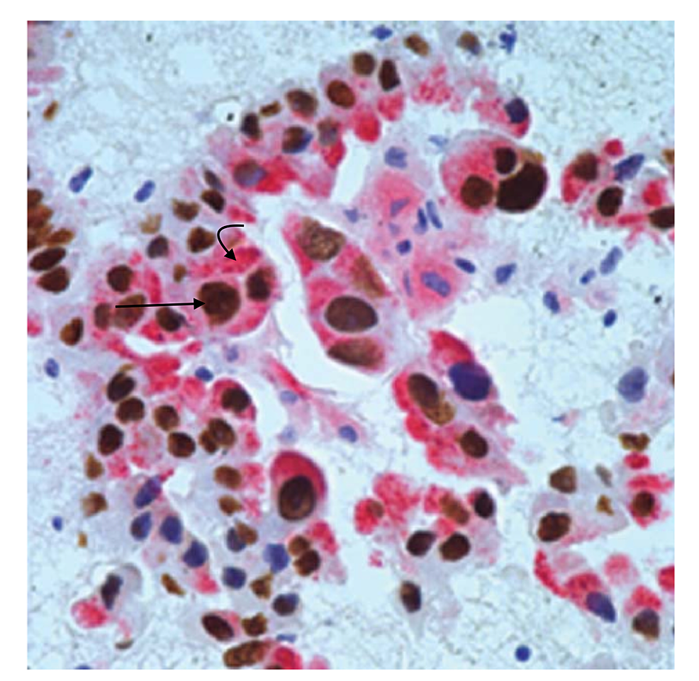 Cureus Adenocarcinoma Of The Lung With Inguinal Lymph Node Metastasis 