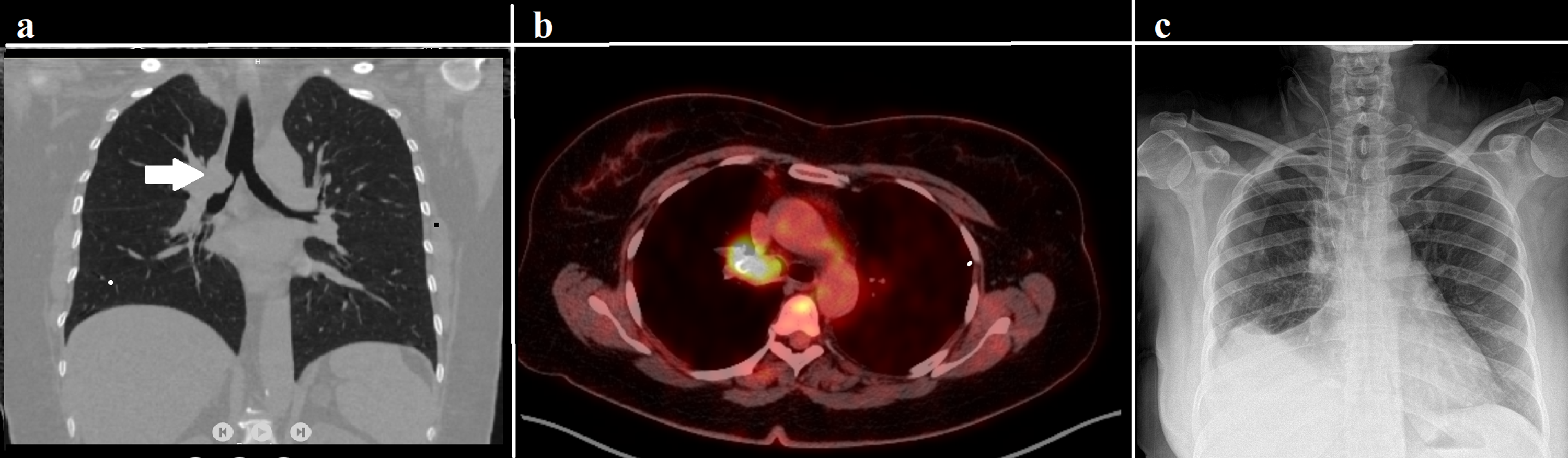 Cureus Videothoracoscopic Bronchial Sleeve Resection for NonSmall