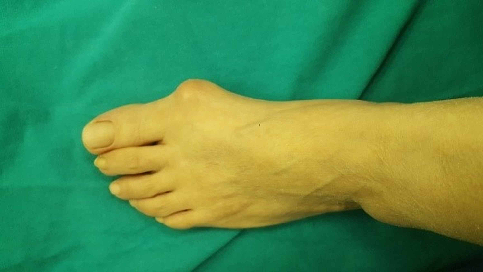 A New Alternative Surgical Treatment of Hallux Valgus, in Moderate to Severe Cases of the Disease With a Two-and-a-Half-Year Follow-Up
