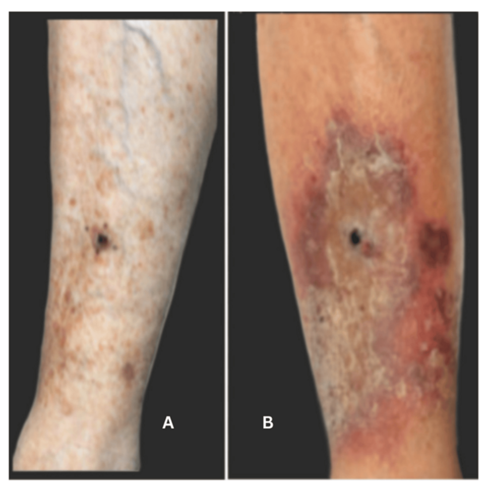 Eruptive Keratoacanthomas in Eosinophilic Annular Erythema