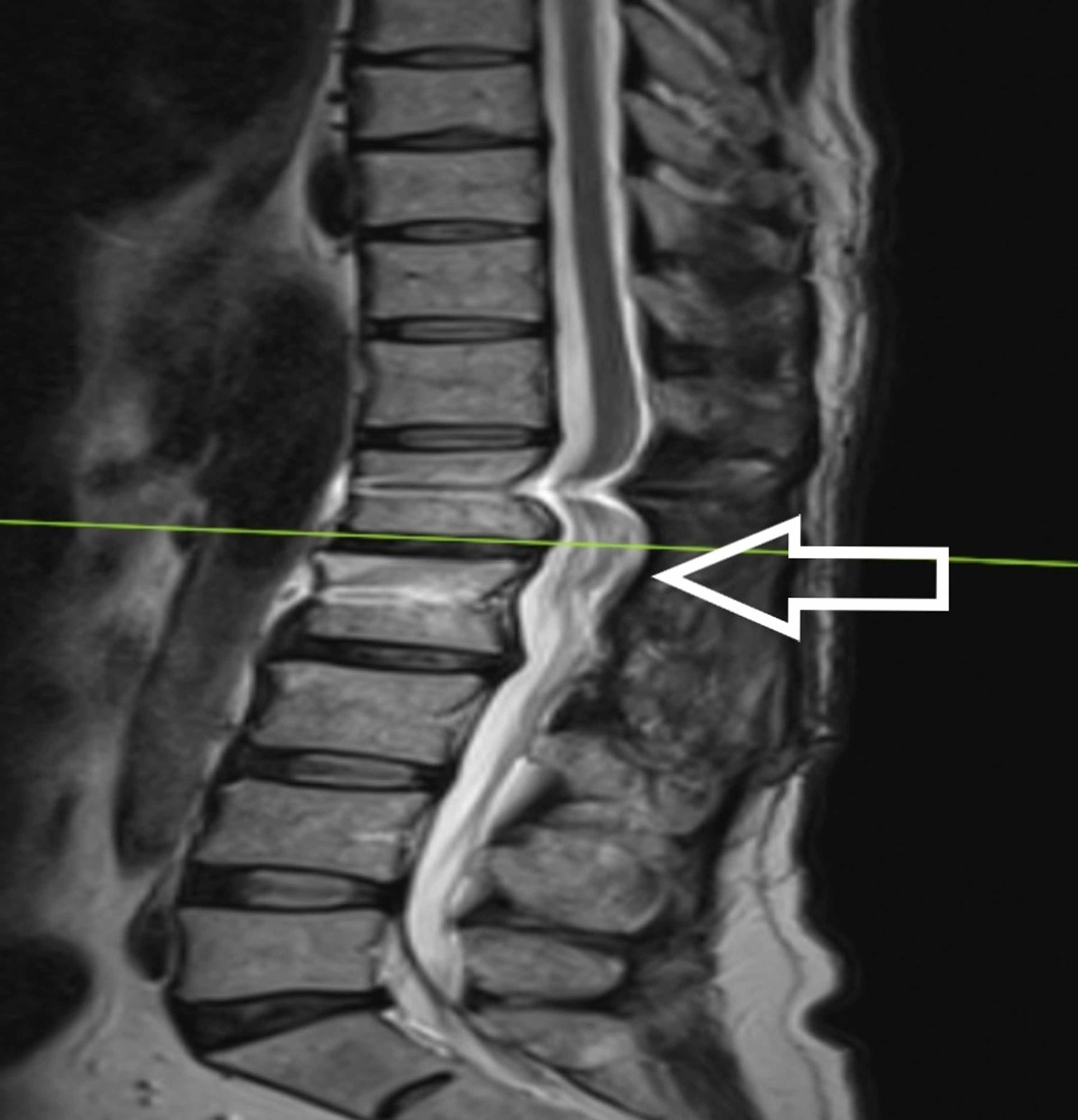 Cureus | Intradural Conus Medullaris Lipoma With Neurological Deficit ...