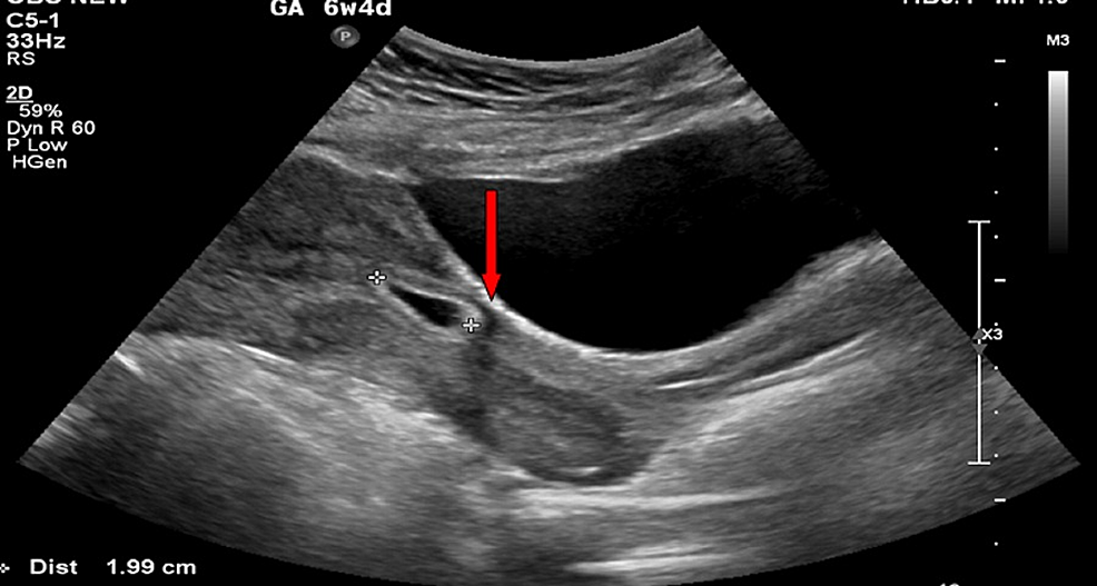 cureus-cesarean-scar-ectopic-pregnancy-a-diagnostic-and-management