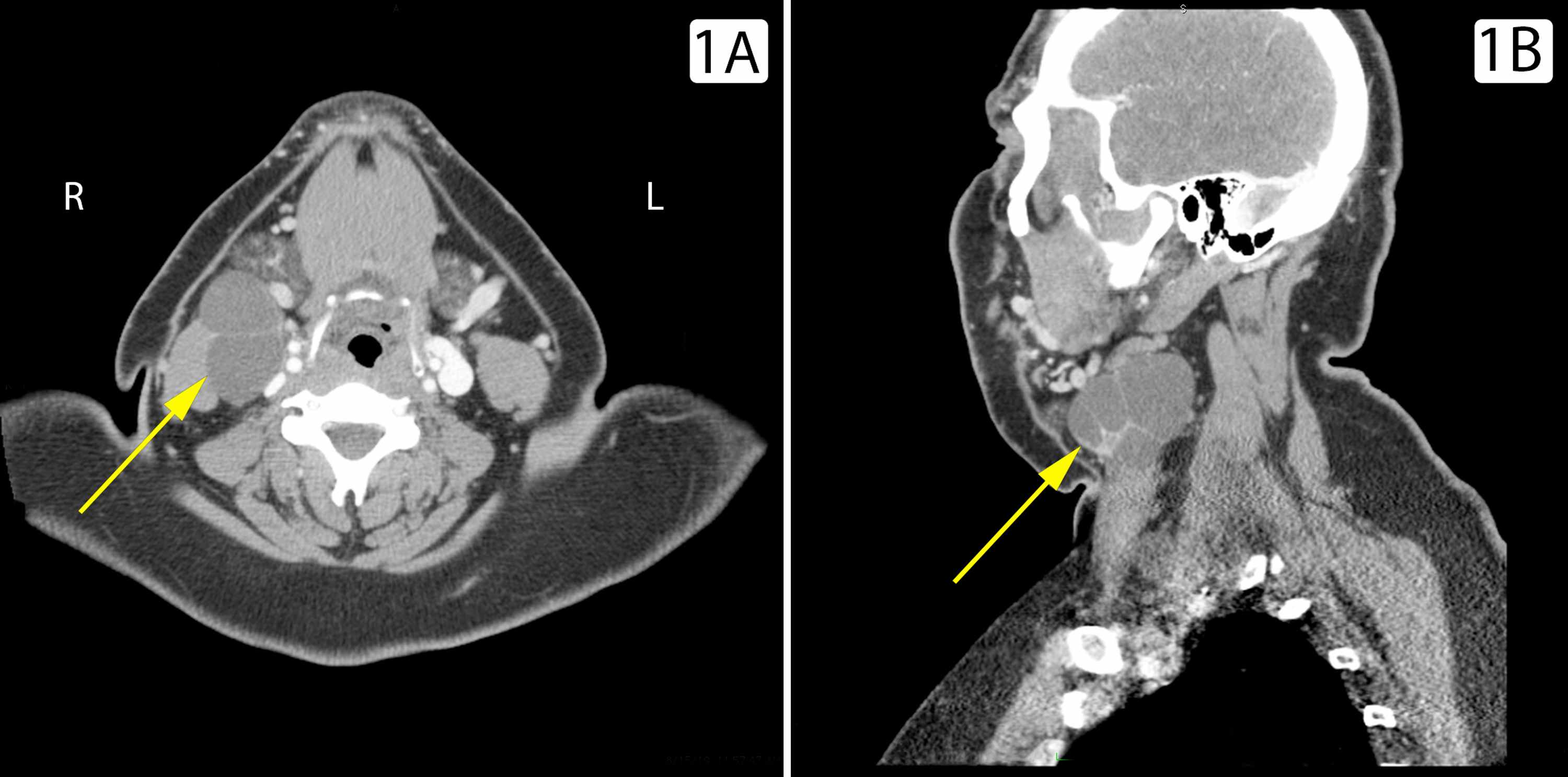 Cureus Branchial Cleft Cyst Harbors Metastatic Papillary Thyroid