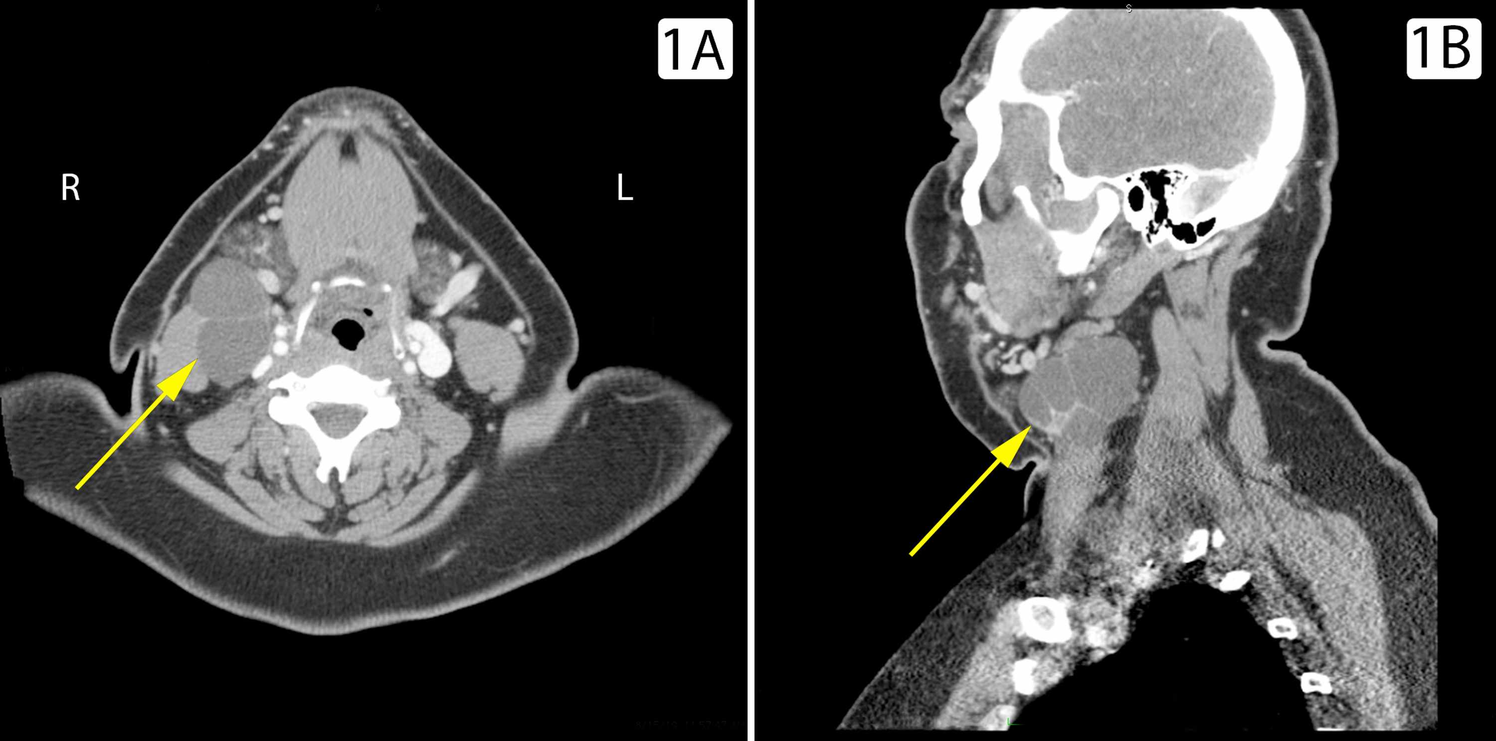 Cureus | Branchial Cleft Cyst Harbors Metastatic Papillary Thyroid ...