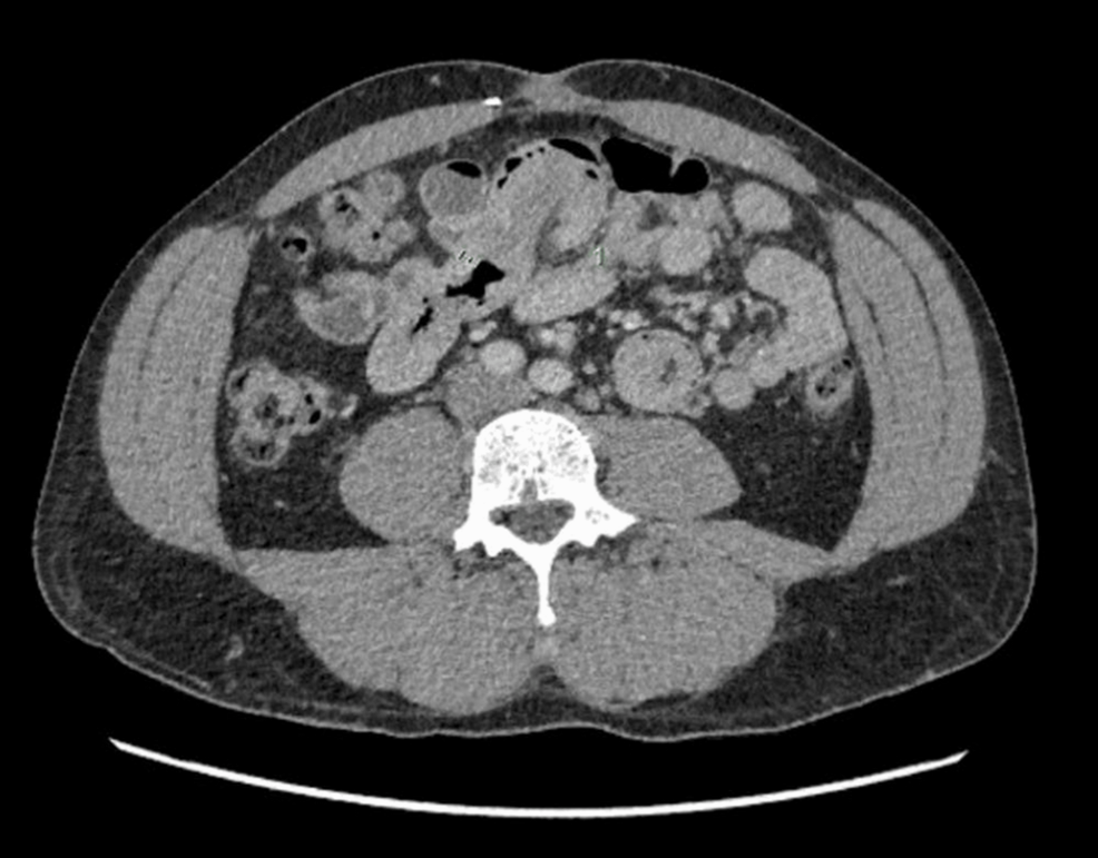 Rare Multiple Transient Small Bowel Intussusceptions in an Adult - News Directory 3