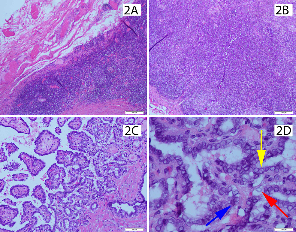 Branchial Cyst Histology