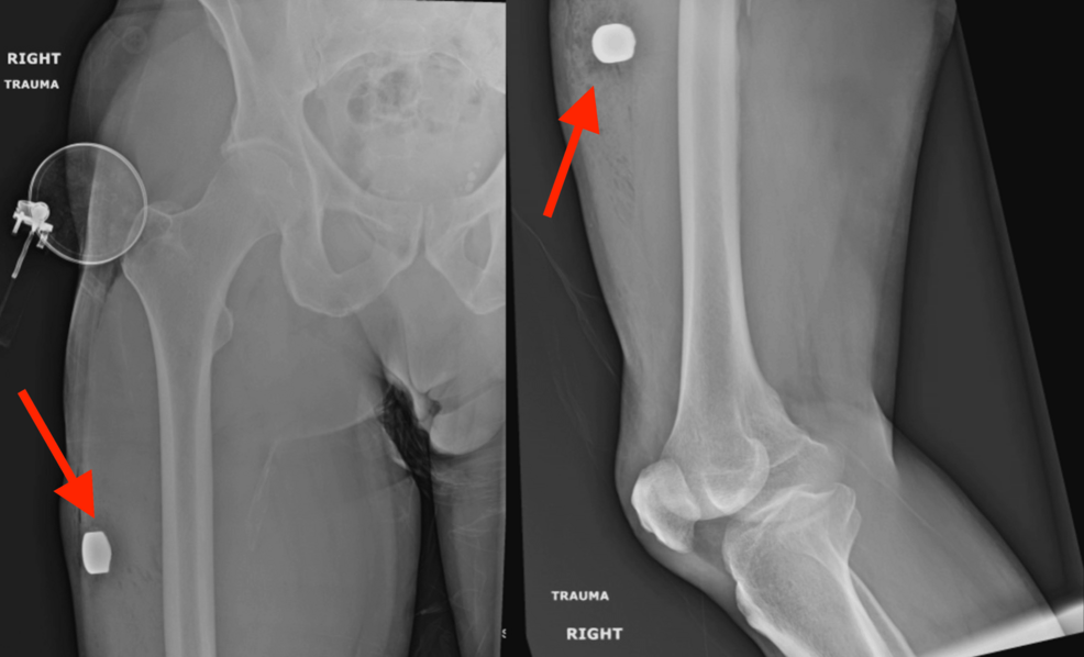 Systemic Barium Toxicity Manifesting As Acute Hypokalemic Paralysis and Respiratory Failure Following a Firework Injury