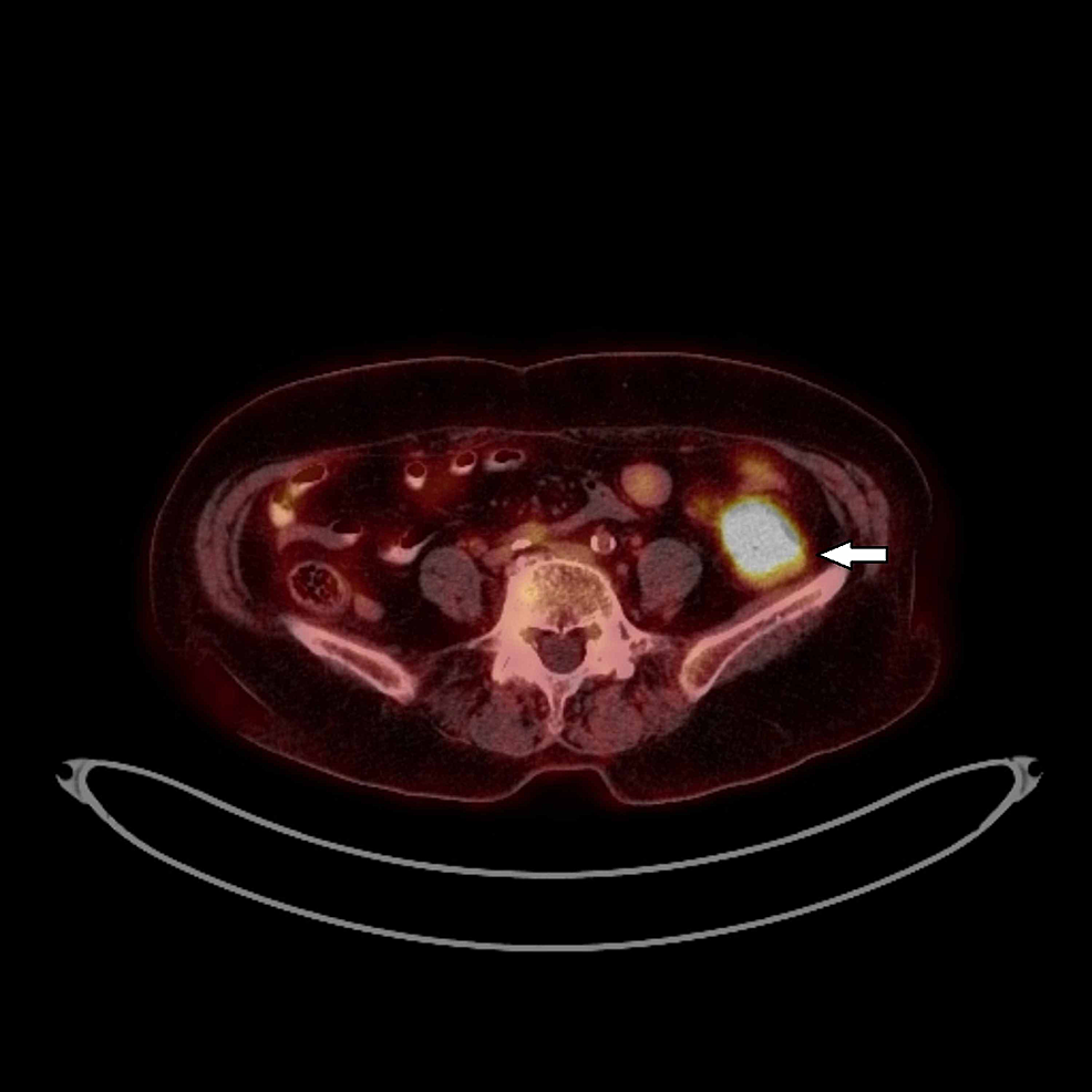 Cureus | A Rare Case of a Metastatic Lung Squamous Cell Carcinoma to