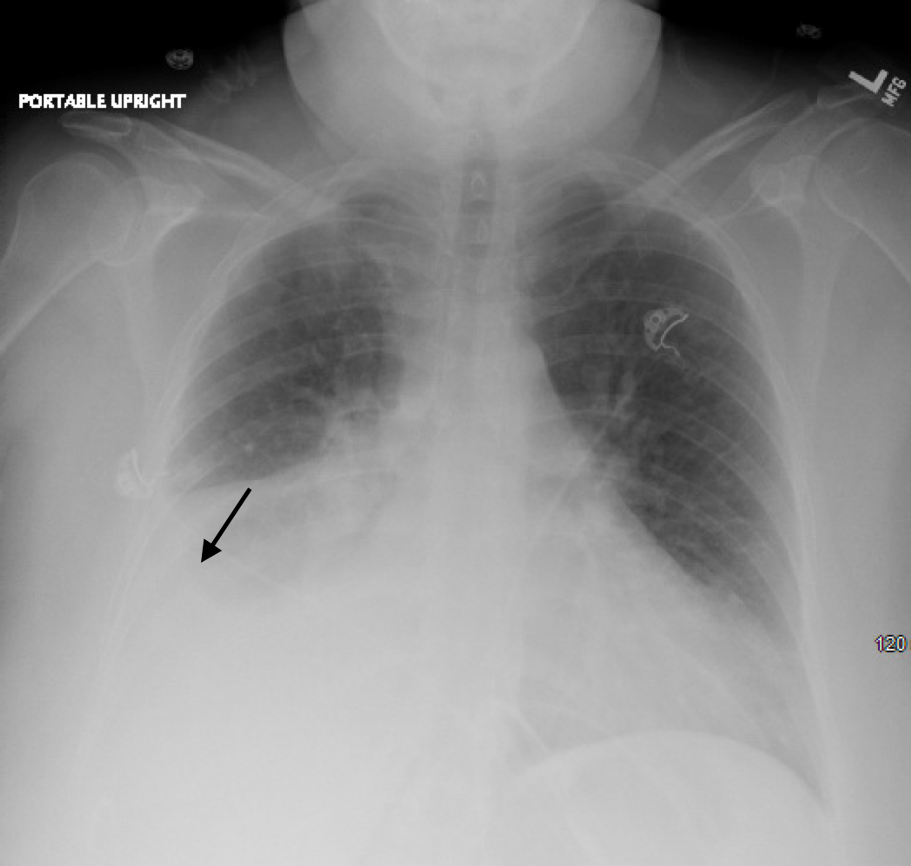 is malignant pleural effusion stage 4