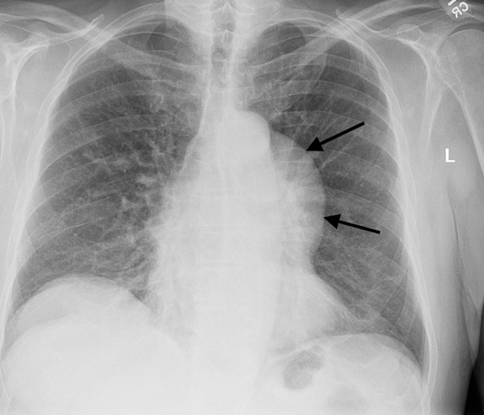 Achromobacter xylosoxidans/denitrificans Bacteremia in a Patient With ...