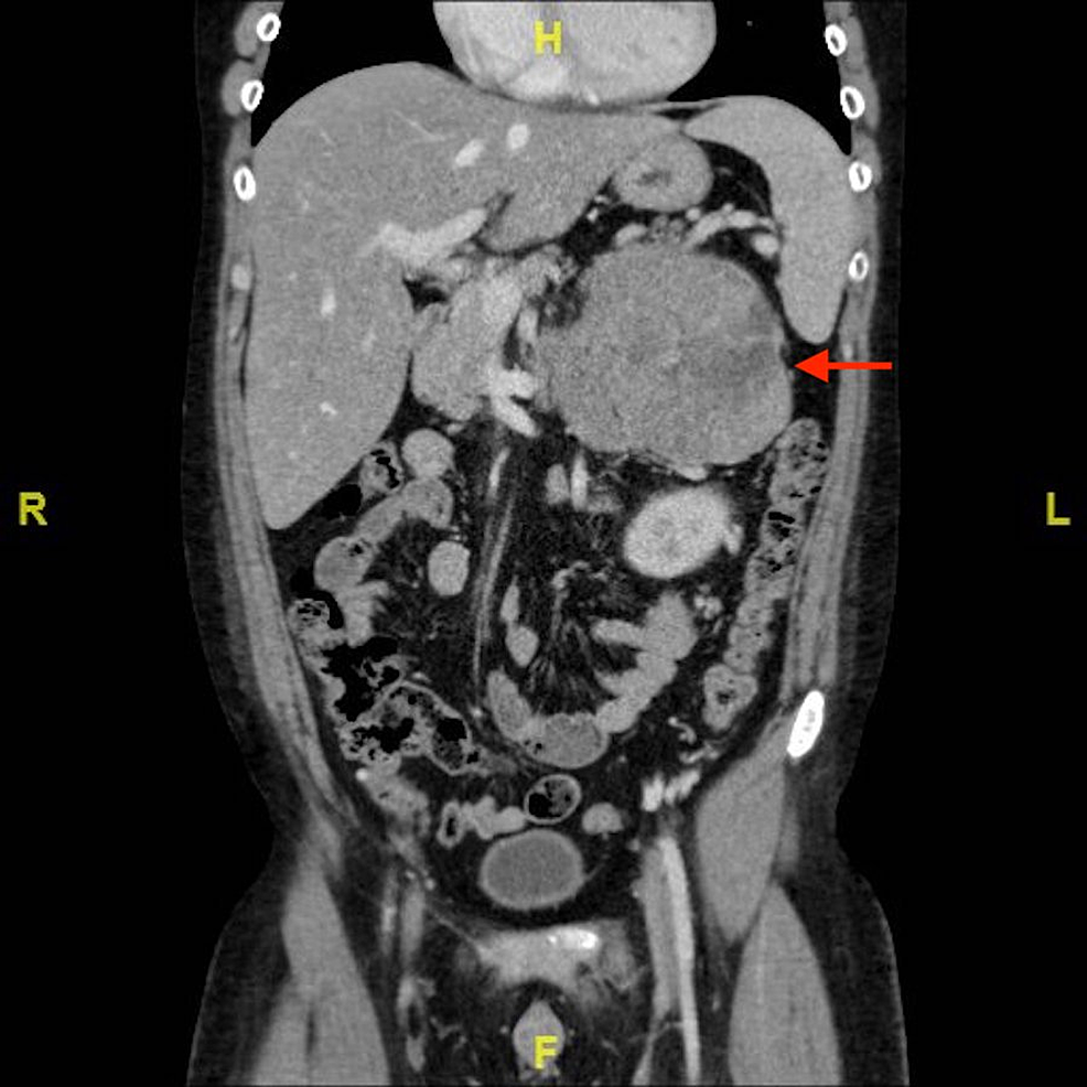 Cureus | Functional Adrenocortical Carcinoma: A Rare Case With Thrombus ...