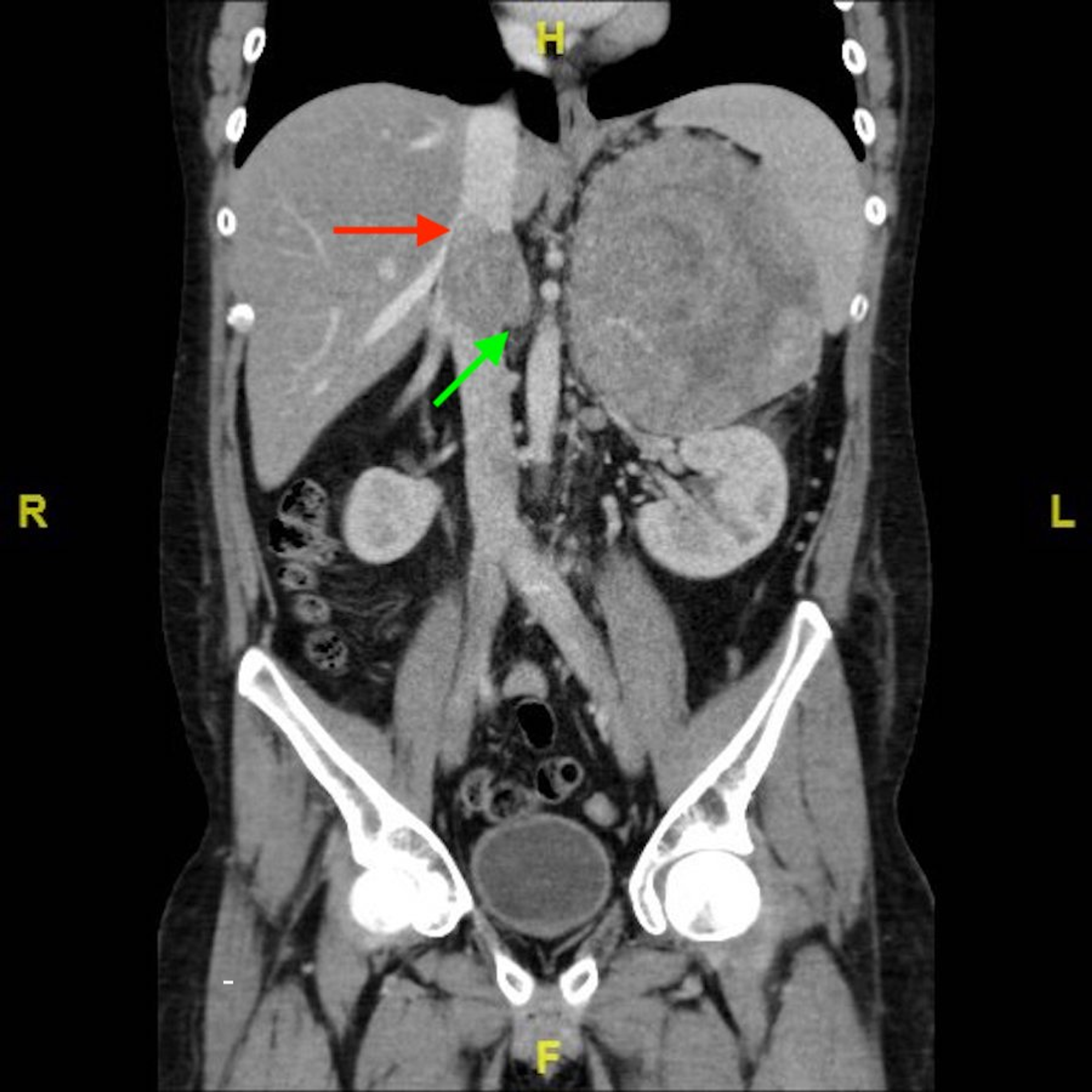 Cureus Ectopic Cushing Syndrome In Adenocarcinoma Of The Lung Case ...