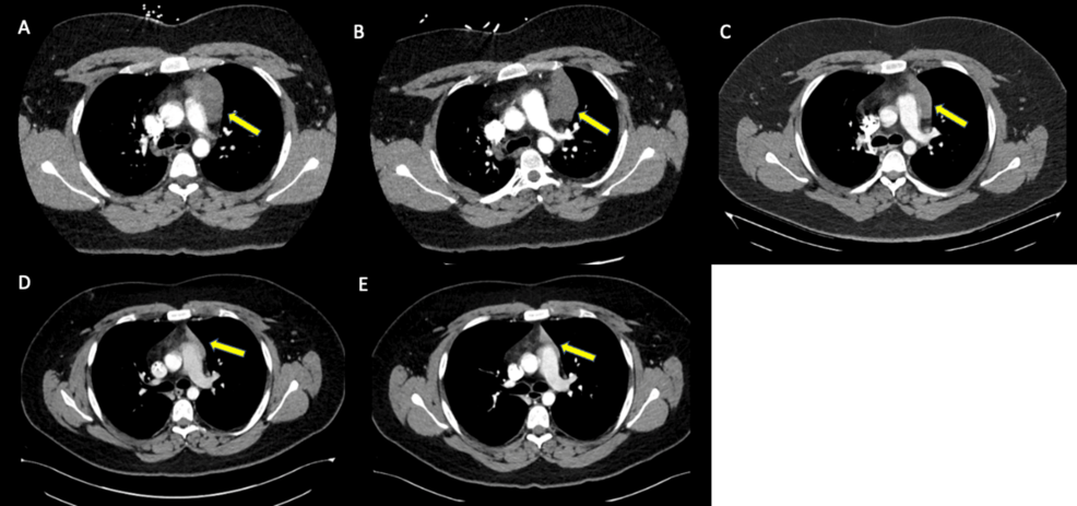 Extragonadal Seminoma: Rare Case of Mediastinal and CNS Involvement - News Directory 3