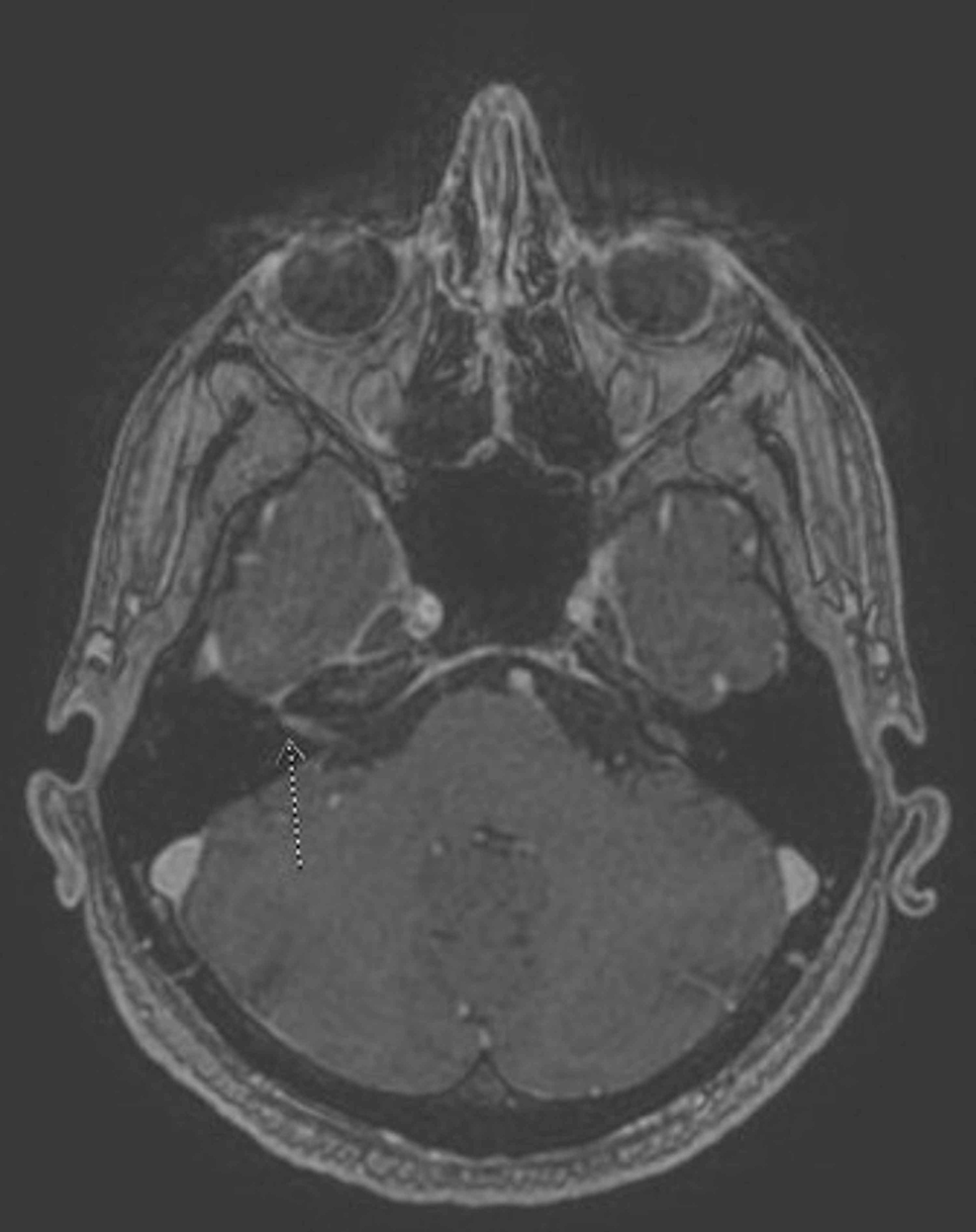 Magnetic-resonance-imaging-(MRI)-of-the-brain