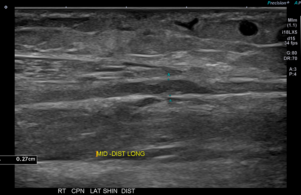 Development of Traumatic Neuromas in a Patient Following Endovenous