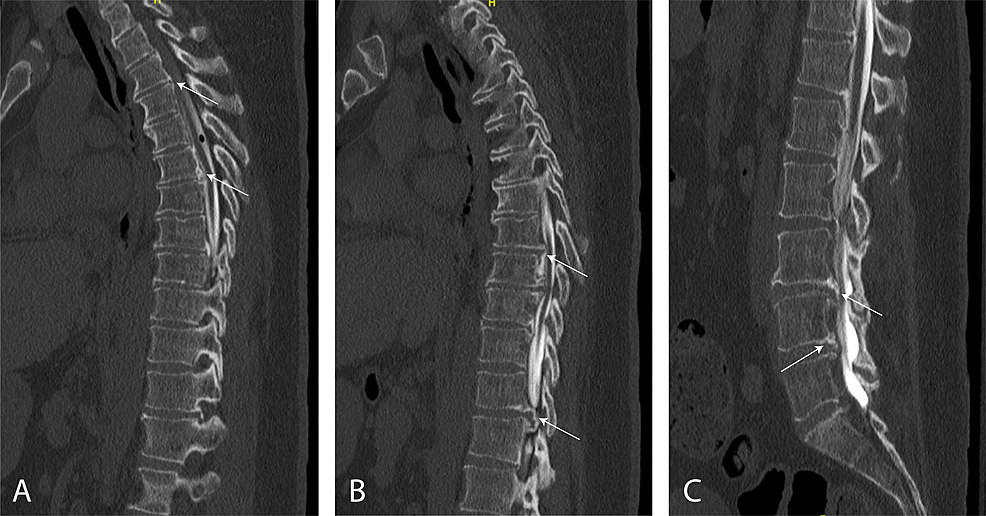 Cureus | Ossification Of The Posterior Longitudinal Ligament In The ...