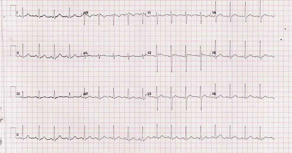 Cureus | Type 2 Brugada Electrocardiogram Pattern Due to Supra ...