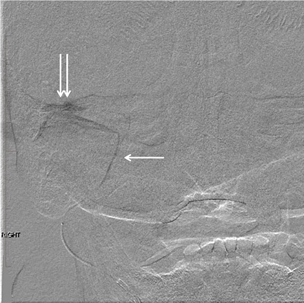 Digital-subtraction-angiogram-with-injection-of-the-right-middle-meningeal-artery.-Note-the-microcatheter-tip-in-the-mid-segment-of-the-right-middle-meningeal-artery-(arrow).-There-is-a-jet-of-contrast-filling-the-large-pseudoaneurysm-in-the-soft-tissues-just-beneath-the-right-middle-cranial-fossa-(double-arrow).