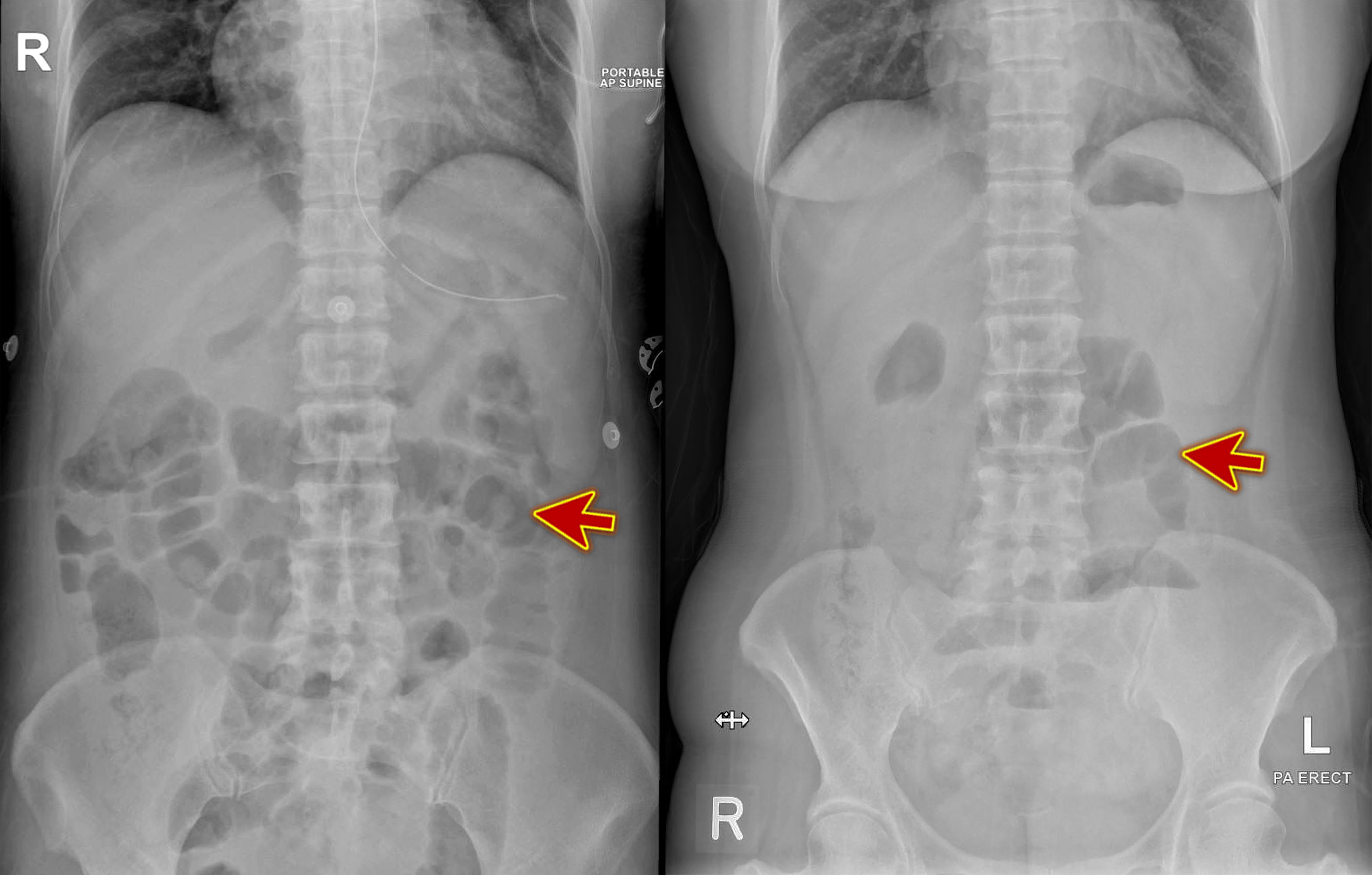Cureus An Unusual Case of Thyroid Storm Masquerading as an Intestinal