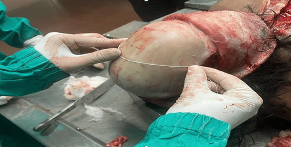 Exploratory Evaluation of Cranial Suture Lengths As Supplementary Indicators of Stature: An Autopsy-Based Morphometric Study in a North Indian Population