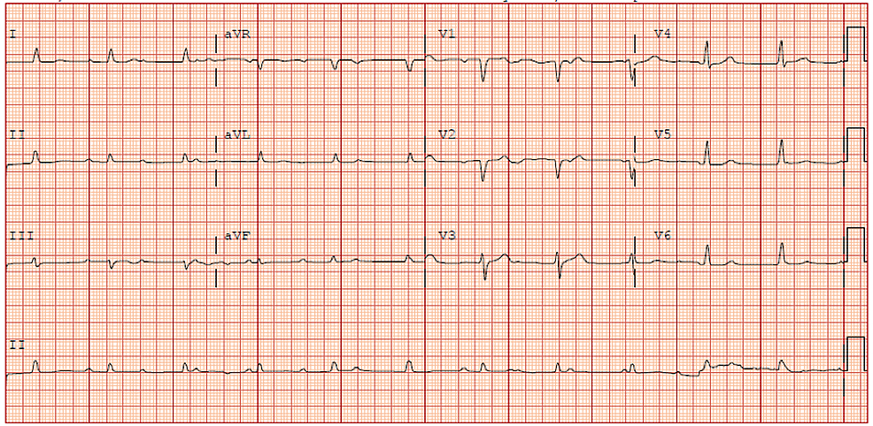 Cureus | Triple Valve Endocarditis With Aortic Root Abscess Presenting ...