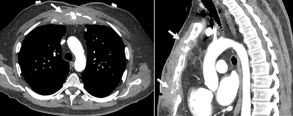 Cureus Primary Sternal Tubercular Osteomyelitis A Rare Cause Of Chronic Chest Pain