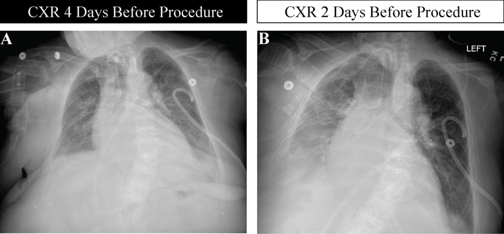 Inability to Ventilate Due to a Sudden Intraoperative Tension Hydrothorax