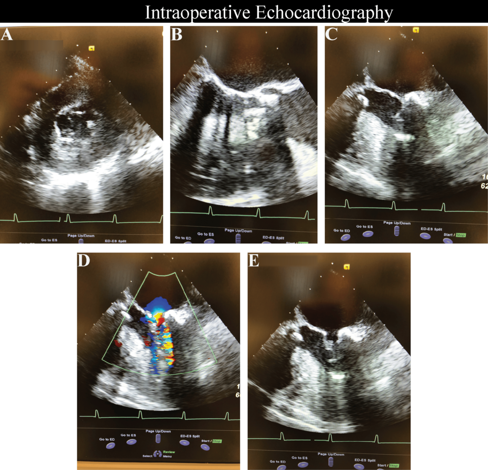 Intraoperative-transesophageal-echocardiography-(TEE)-demonstrating-severe-concentric-left-ventricular-(LV)-hypertrophy-with-a-small,-underfilled-LV-cavity-and-combined-aortic-and-mitral-stenosis-physiology