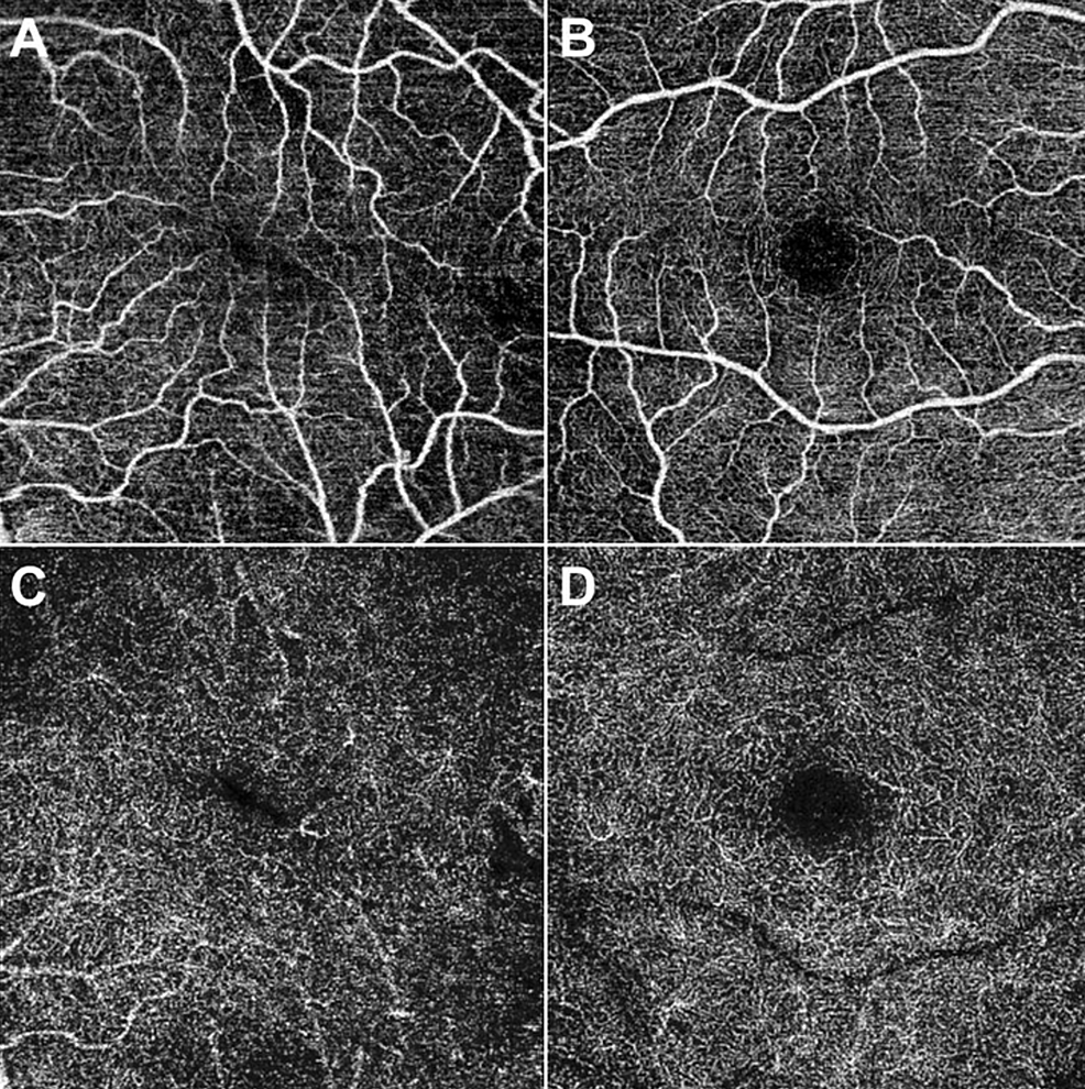 Cureus Reduction of Foveal Avascular Zone After Vitrectomy