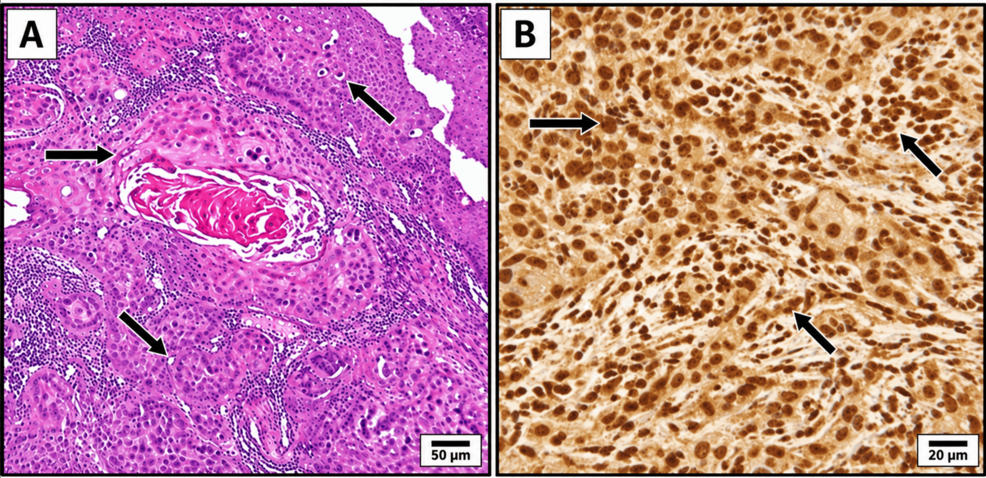Clinicopathological Profile of 1,000 Head and Neck Squamous Cell Carcinoma Cases