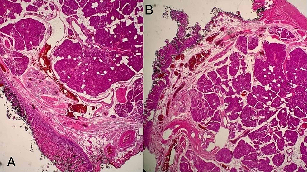 Jejunal Intussusception Due To Heterotopic Pancreas A Case Report Cureus