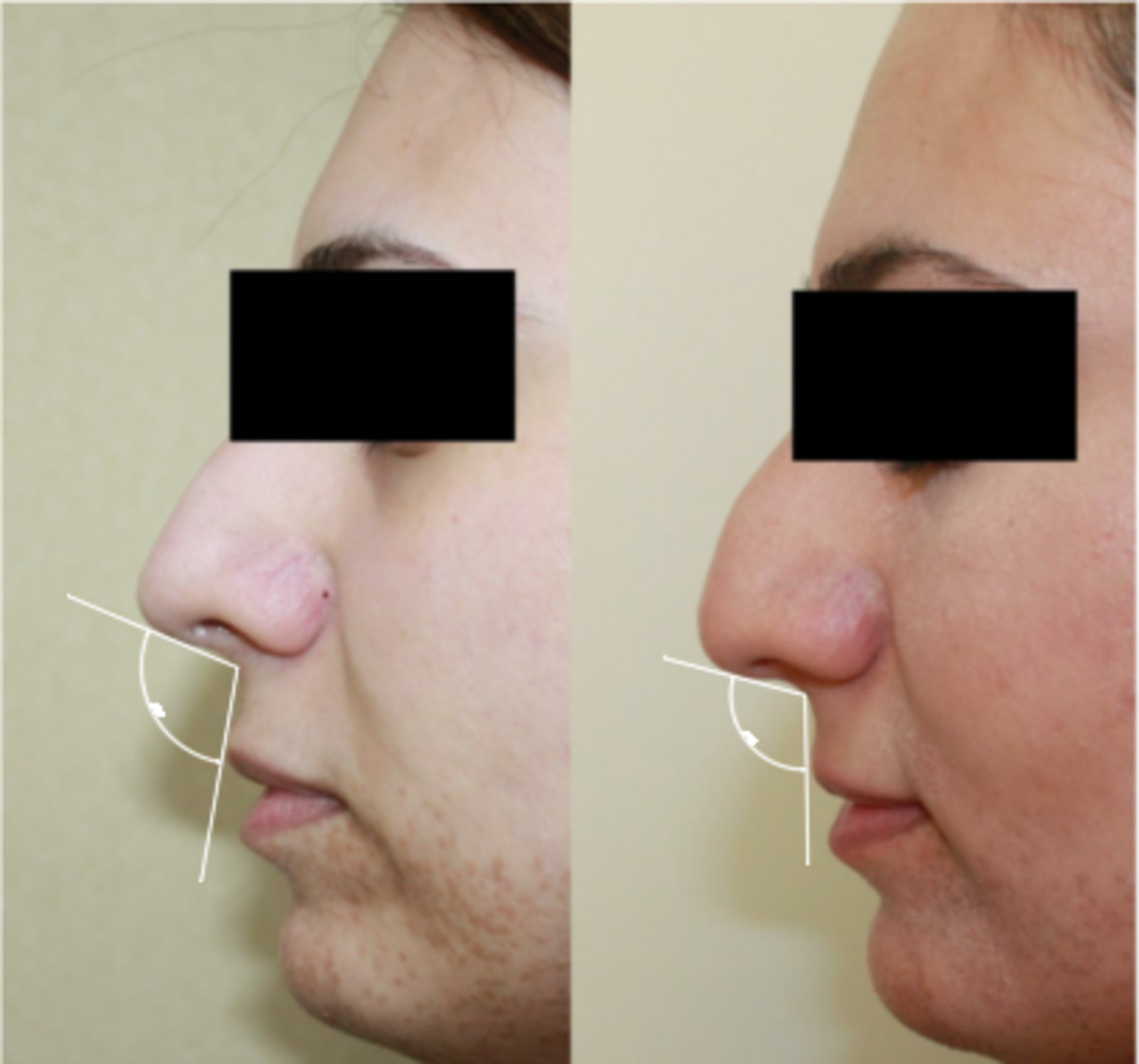 Cureus The Nasal Tip Rotation After Primary Rhinoplasty Using