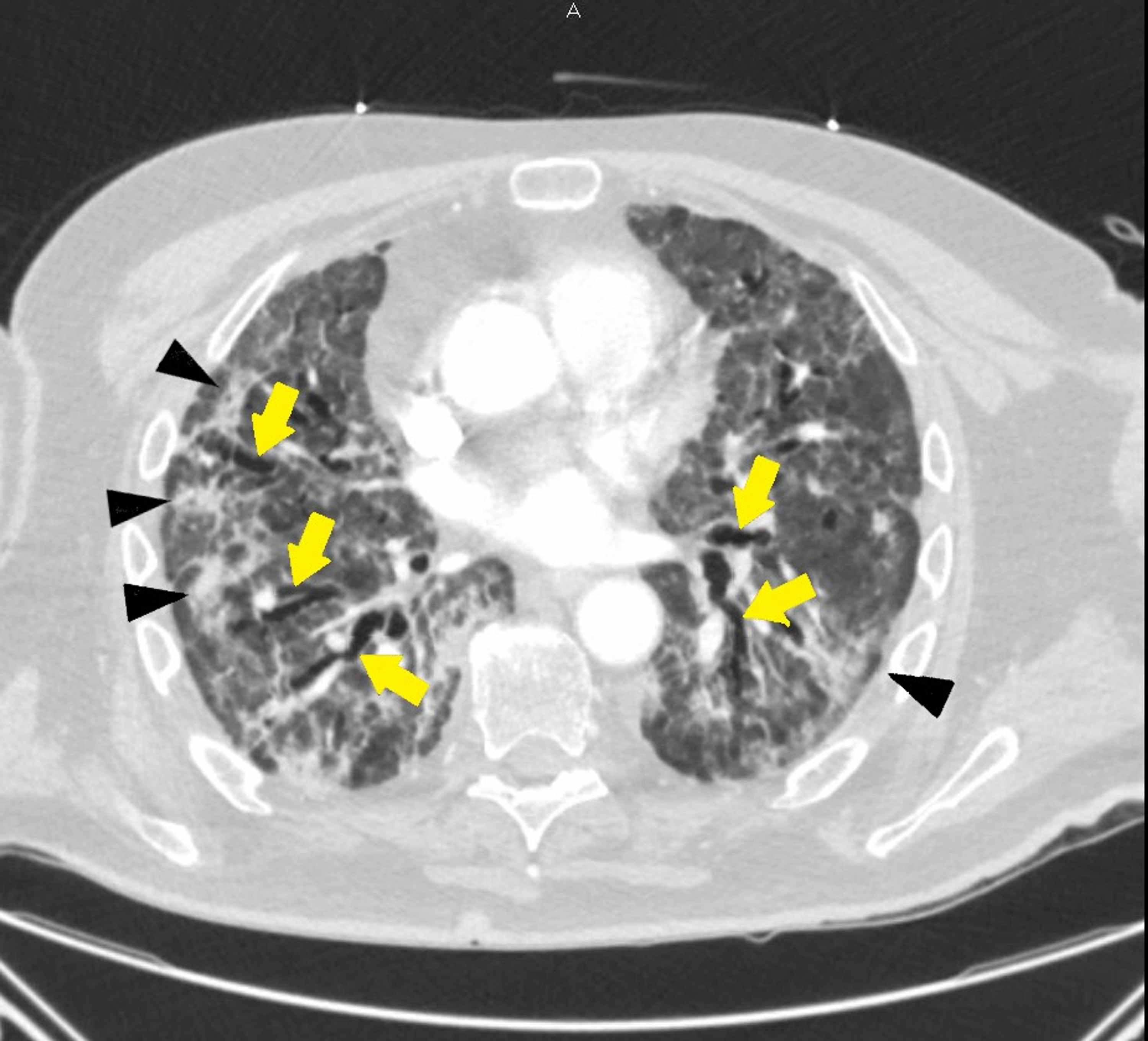 Cureus | Pulmonary Fibrosis After COVID-19 Pneumonia