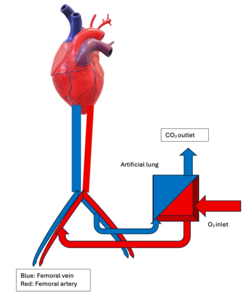 The Evolving Role of Extracorporeal Carbon Dioxide Removal in Acute Respiratory Failure: A Narrative Review