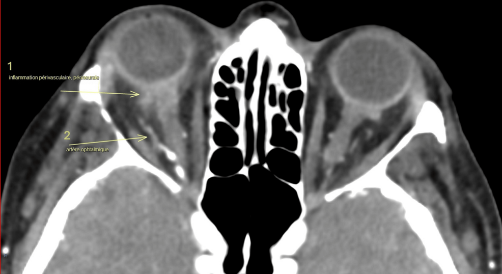Giant Cell Arteritis: Cranial and Systemic Manifestations - News Directory 3
