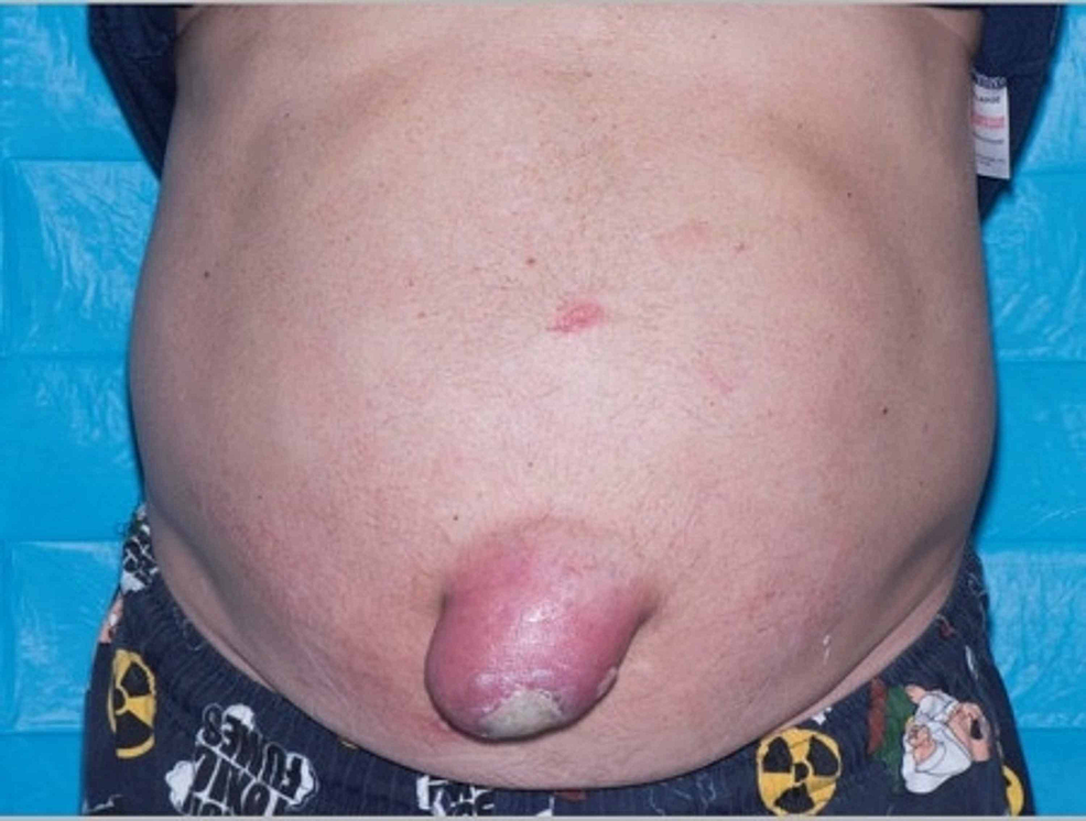 Cureus, The Complexity of Managing a Burned Irreducible Umbilical Hernia  in an Adult