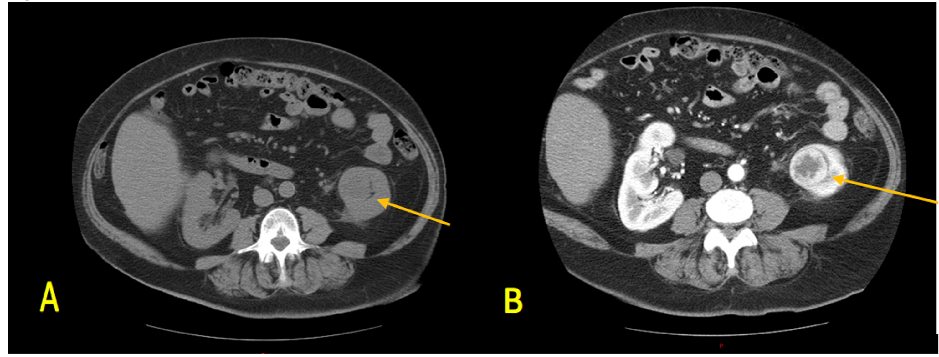 Cureus | Primary Renal Carcinoid: Two Rare Cases at a Single Center