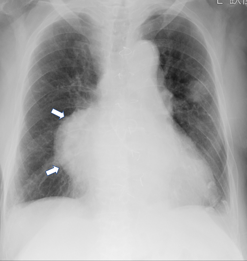 Successful Percutaneous Closure of a Large Saphenous Vein Graft ...