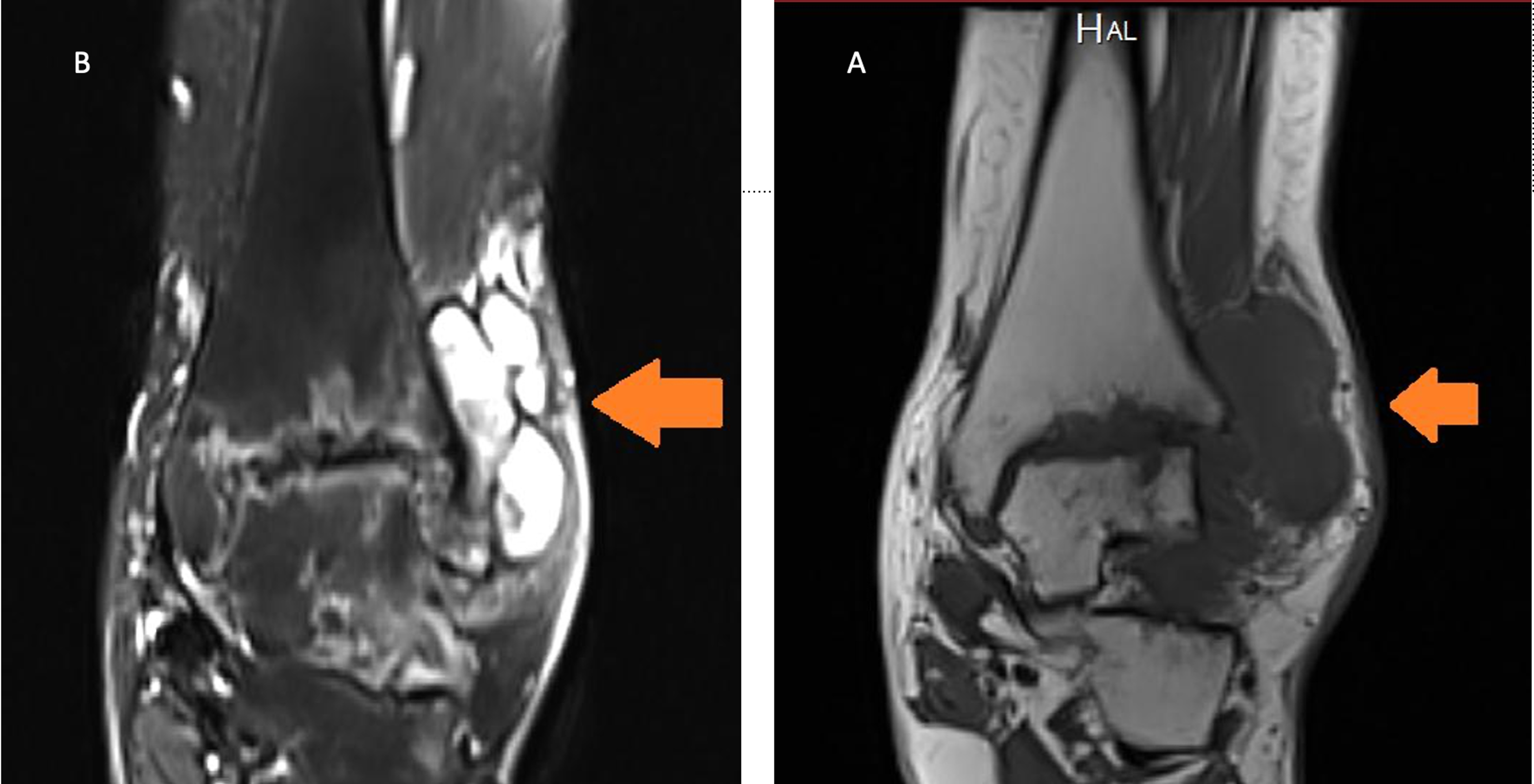 Cureus Tuberculous Arthritis of the Ankle Joint Mimicking Pigmented