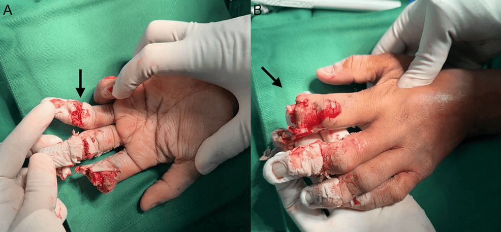 Salvaging Mutilating Hand Injuries: Case Report on Digital Crush and Open Fractures - News Directory 3