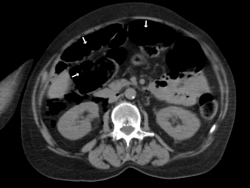 Cureus Intestinal Perforation A Rare Complication Of Treatment With Bevacizumab 4617