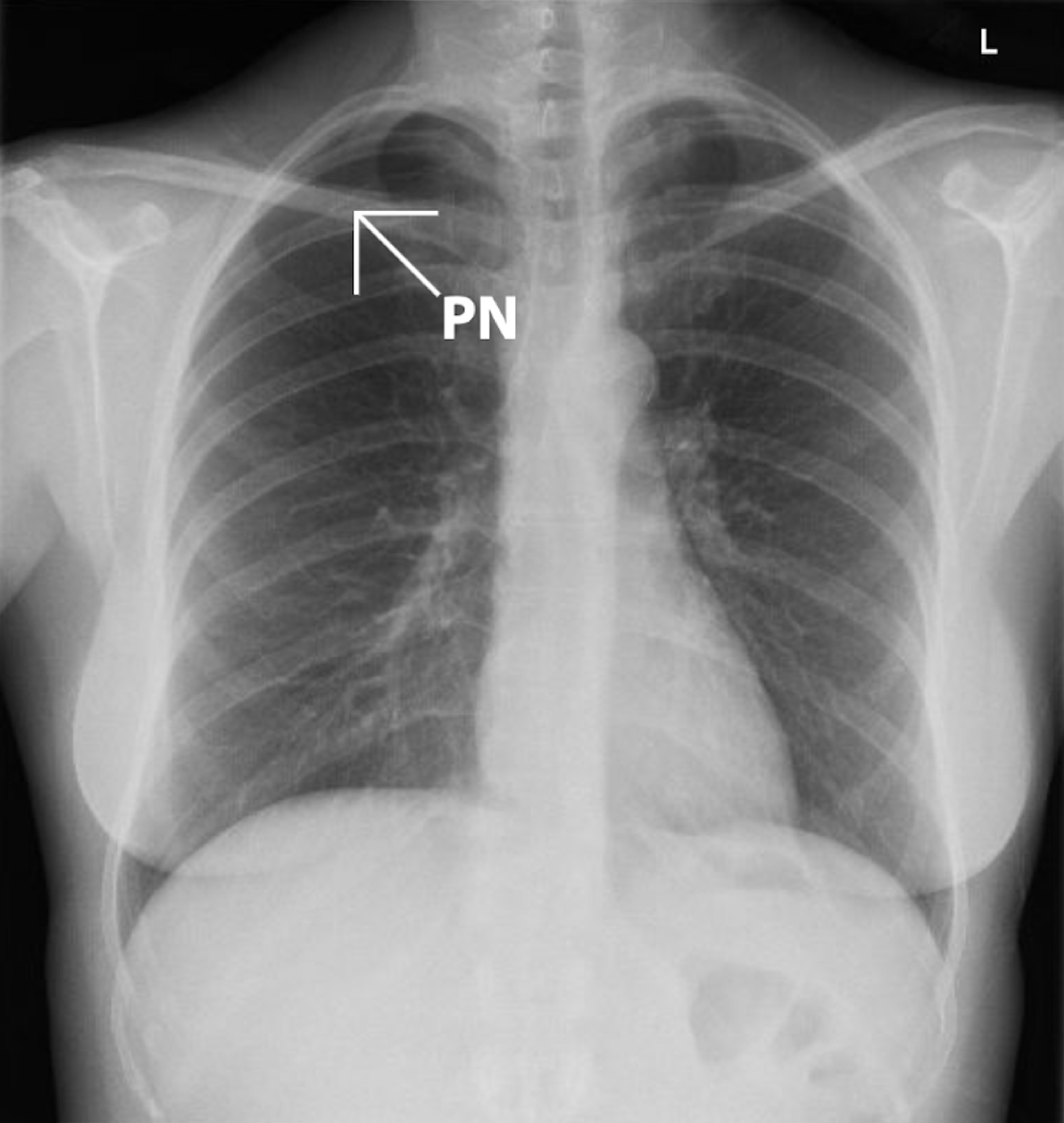 Chest X Ray Showing Large Left Pneumothorax With Coll