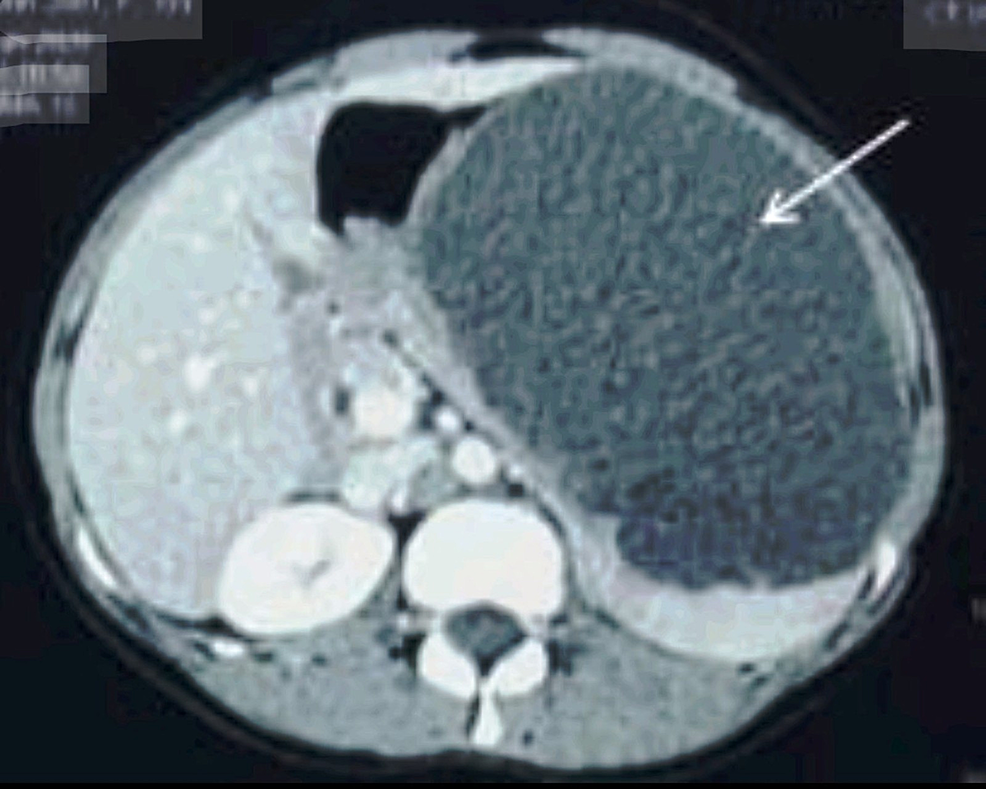 Cureus Large Splenic Cyst A Rare Presentation