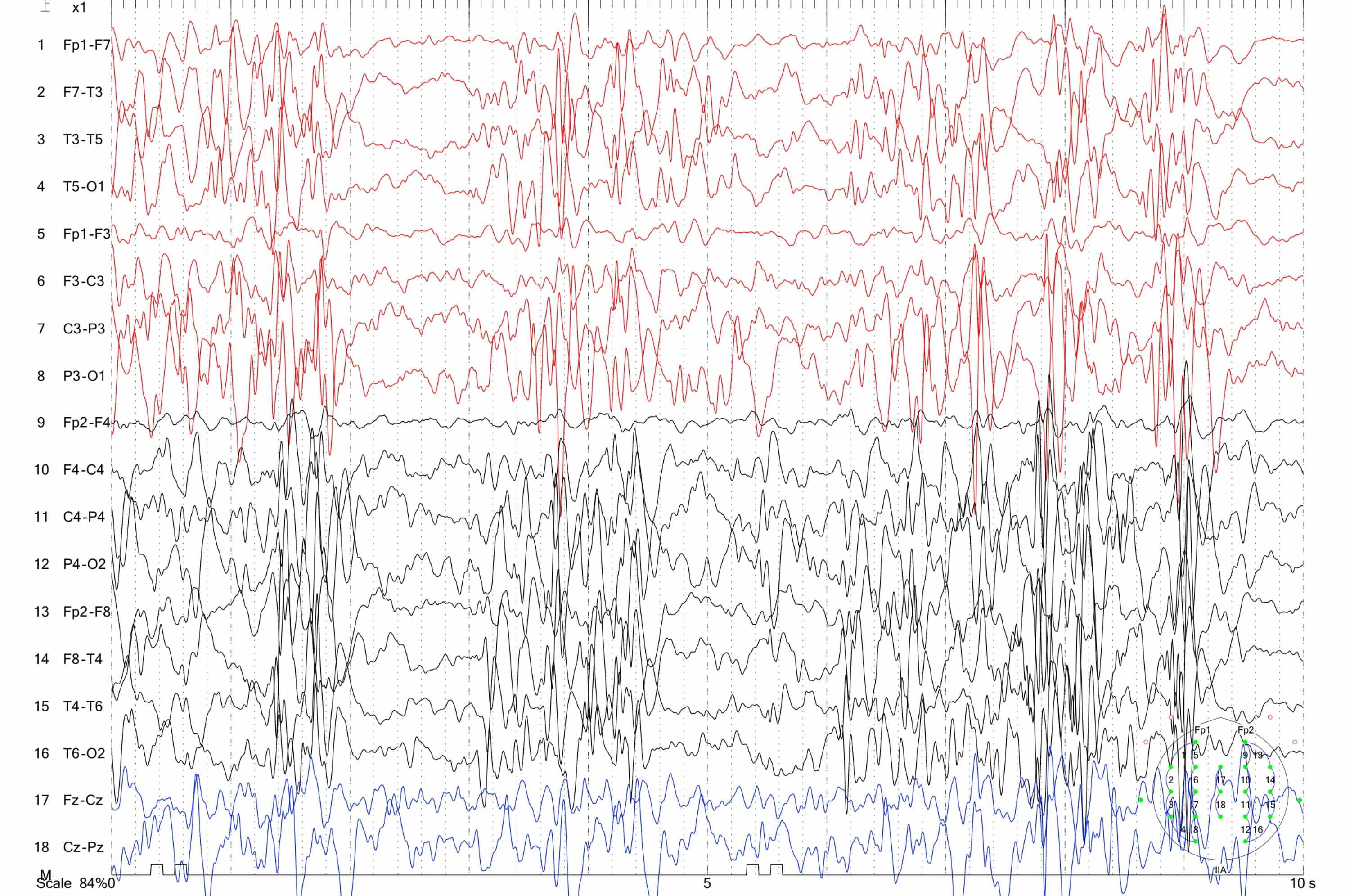 Cureus Vitamin B12 Deficiency Observed in Children With First