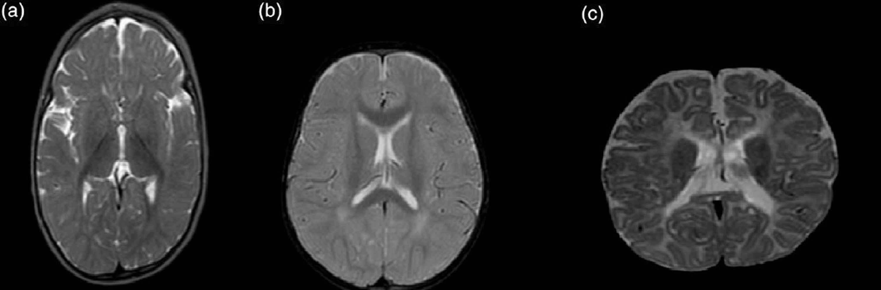 Cureus Vitamin B12 Deficiency Observed in Children With First