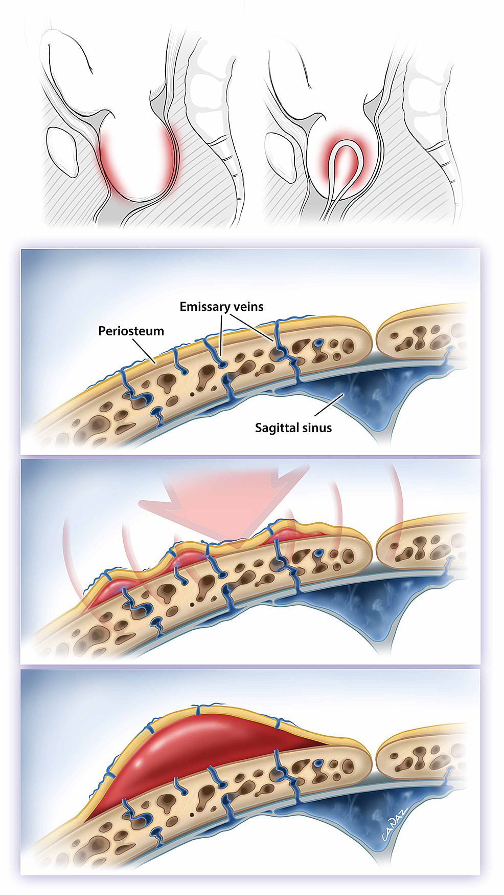 Cureus Observational Case Analysis of Neonates With Large Cephalohematoma