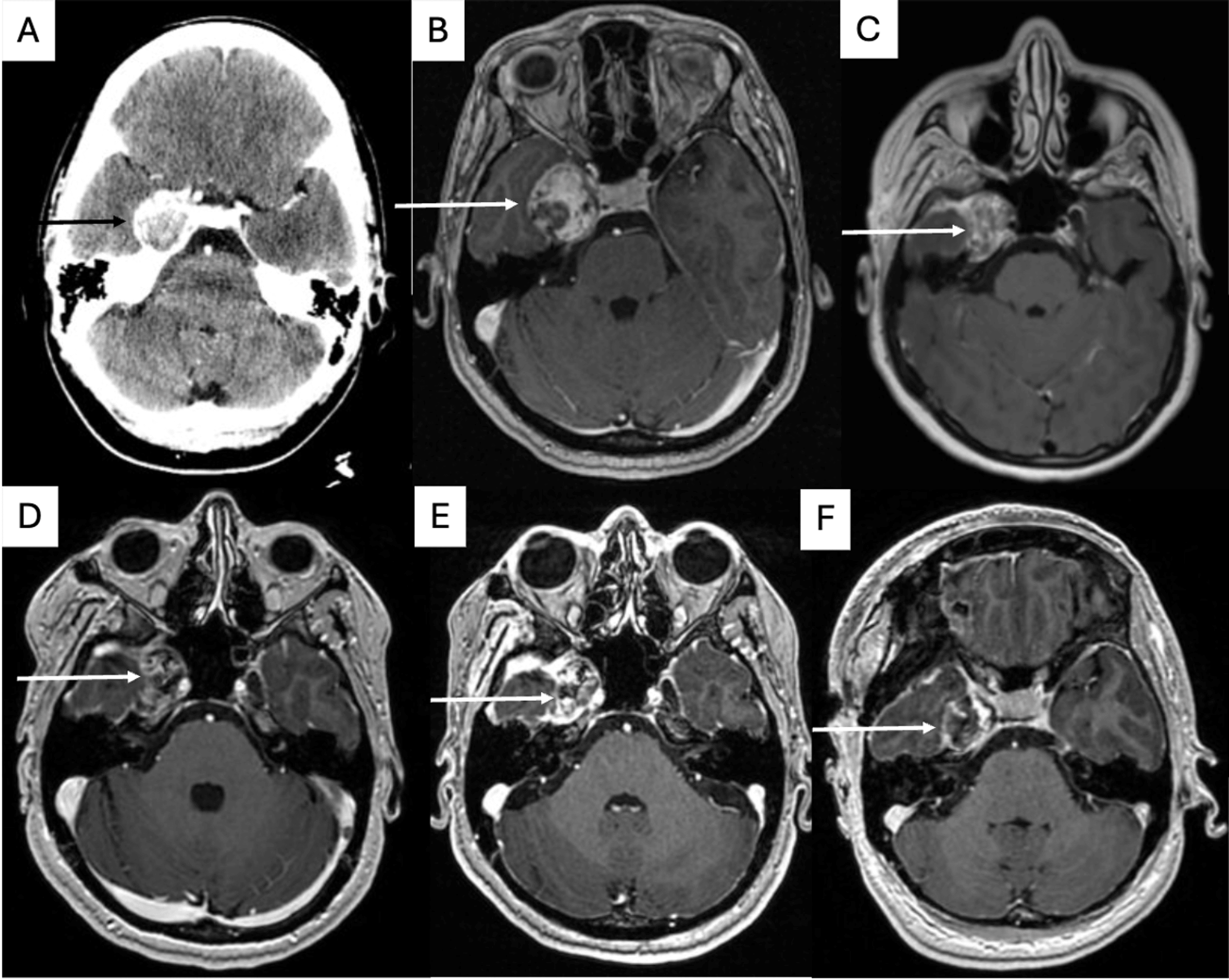 Stereotactic Radiosurgery for Malignant Melanotic Nerve Sheath Tumors: A Case Series