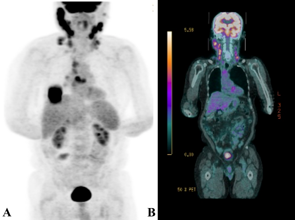 Extra-Nodal, Nasal, Natural Killer T-Cell Lymphoma Treated With a ...