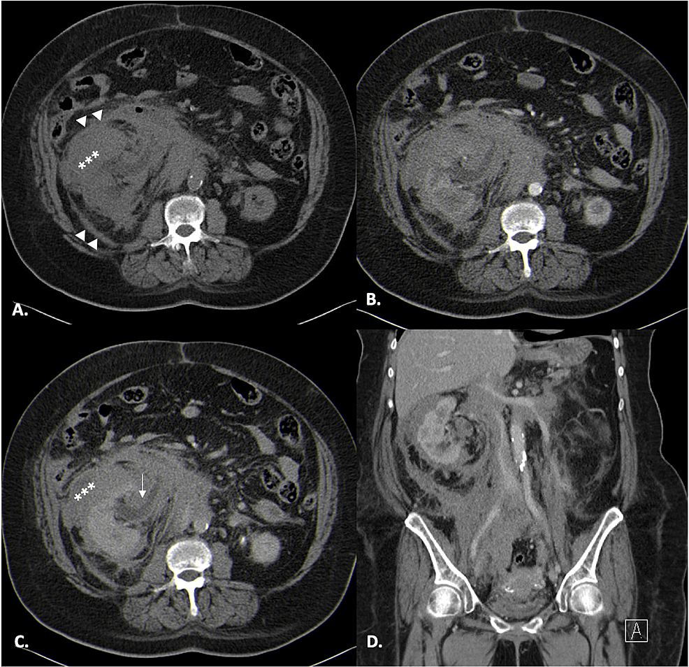 Cureus Renal Lymphoma Mimicking A Retroperitoneal Hematoma   Article River Ae79f340a08e11ebb2b9c342ffc565b2 Fig1s 